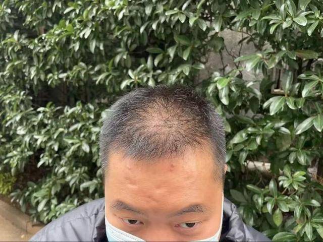 “还能反光<strong></p>
<p>怎么验证虚拟币真假</strong>！”长沙男子植发近9月称后脑勺“像狗啃过”