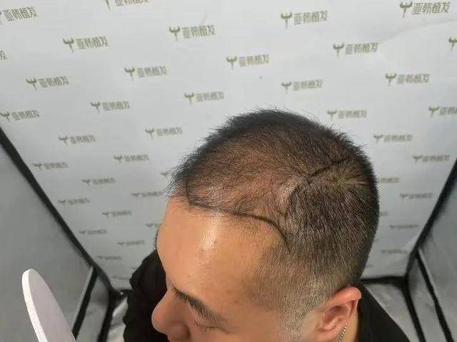 “还能反光<strong></p>
<p>怎么验证虚拟币真假</strong>！”长沙男子植发近9月称后脑勺“像狗啃过”