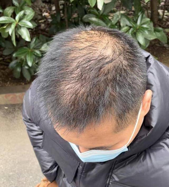 “还能反光<strong></p>
<p>怎么验证虚拟币真假</strong>！”长沙男子植发近9月称后脑勺“像狗啃过”