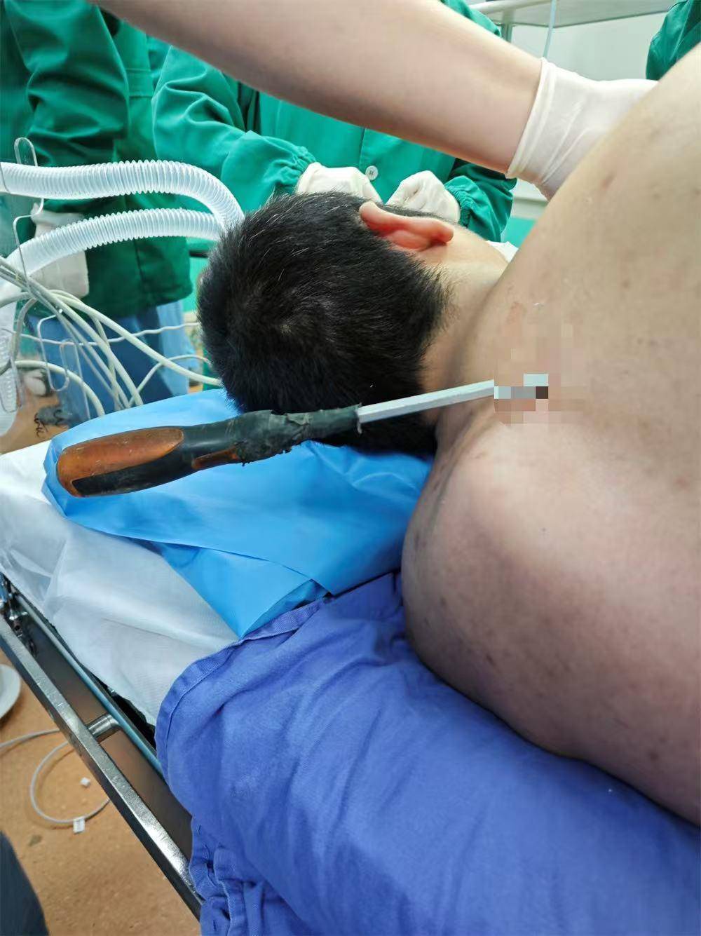 20米高空掉落螺丝刀直插男子胸腔<strong></p>
<p>bcc币虚拟货币名称</strong>！医生：不要自行拔除