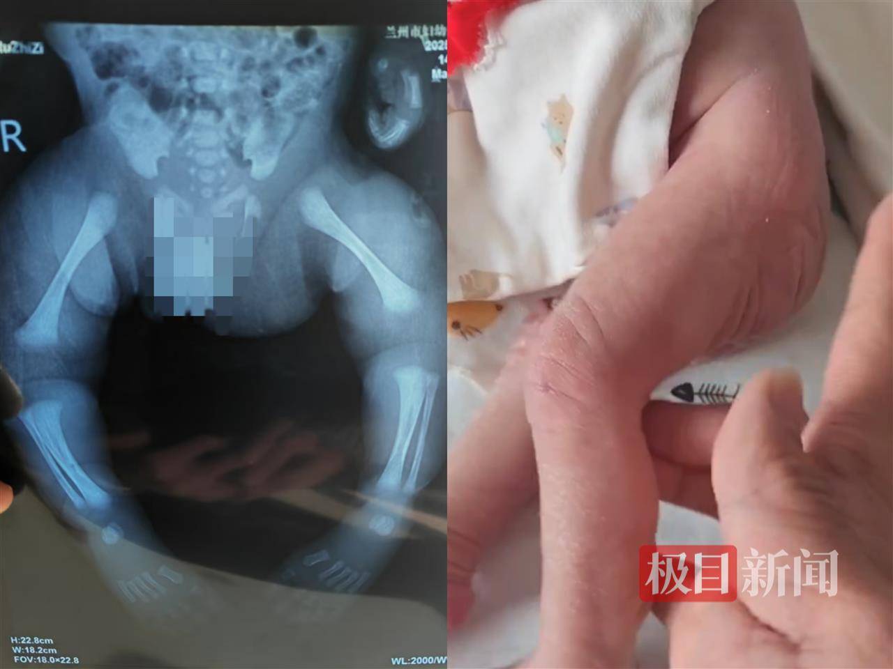 二胎出生查出先天性病症或落下残疾<strong>，残疾父母称医院产检漏检、未尽告知义务，医院及医调委回应