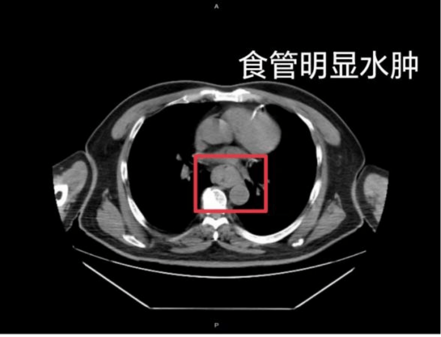 【家常话健康】一口热汤<strong></p>
<p>虚拟币天王</strong>，差点要了幼童的命！不是所有东西都适合“趁热吃”