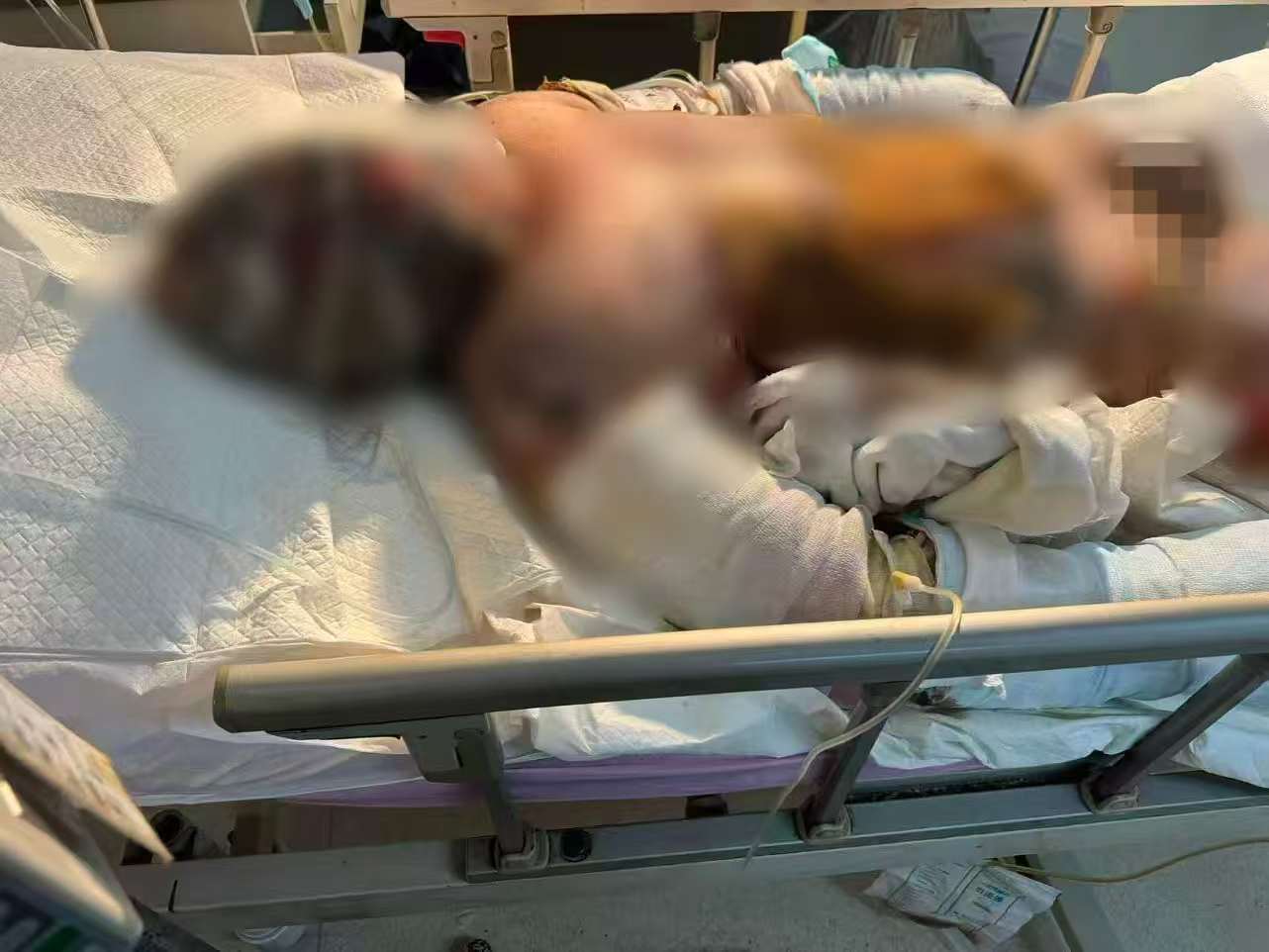 父子在哈尔滨一亲戚公司上班遇爆炸全身烧伤<strong></p>
<p>虚拟火币</strong>，治疗花费近百万公司拒赔偿？亲戚回应