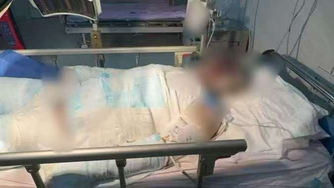 父子在哈尔滨一亲戚公司上班遇爆炸全身烧伤<strong></p>
<p>虚拟火币</strong>，治疗花费近百万公司拒赔偿？亲戚回应