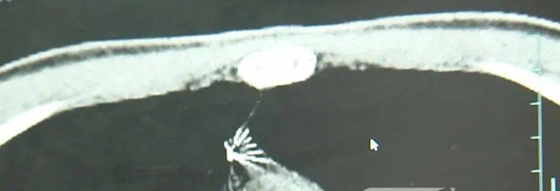 17岁小伙参军体检发现胸腔内有根5cm缝衣针<strong></p>
<p>虚拟币btt</strong>,父母回忆或是1岁时扎入,取出时已锈迹斑斑