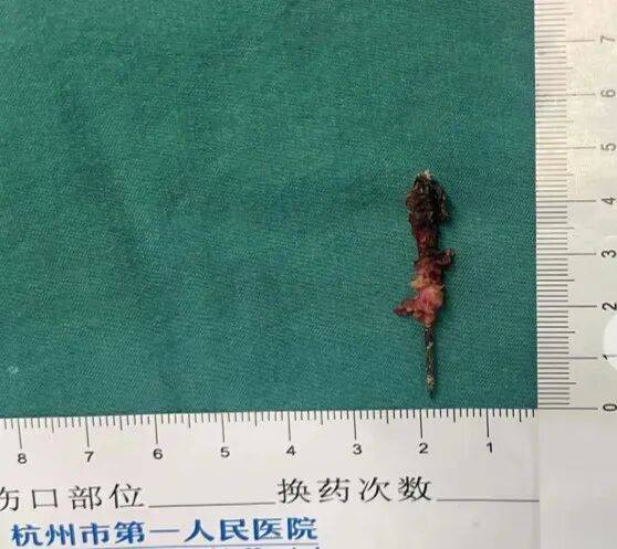 17岁小伙参军体检发现胸腔内有根5cm缝衣针<strong></p>
<p>虚拟币btt</strong>,父母回忆或是1岁时扎入,取出时已锈迹斑斑